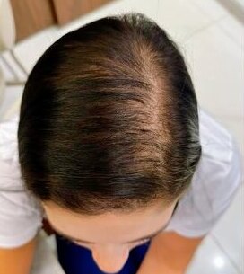 Depois do tratamento: mais densidade capilar